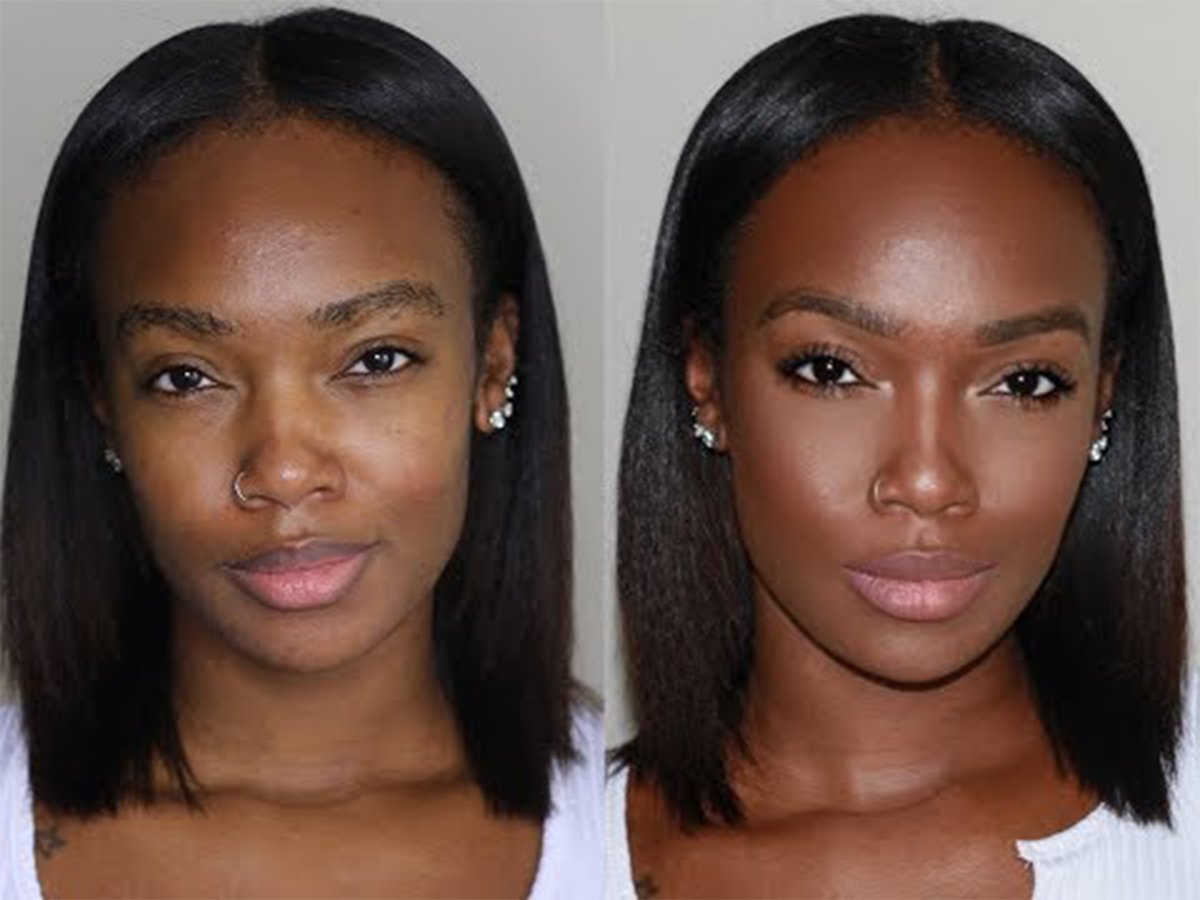 Liquid Rhinoplasty